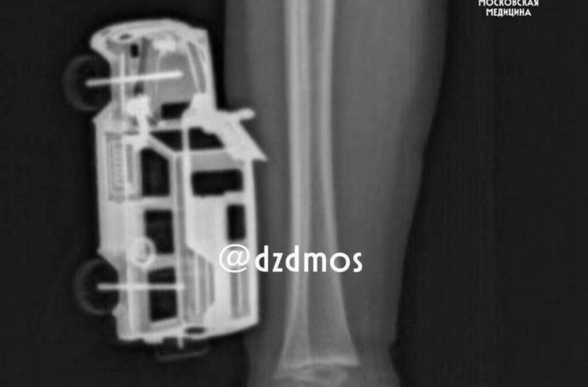 Игрушечную машинку, впившуюся в ногу ребенка, пришлось удалять хирургам