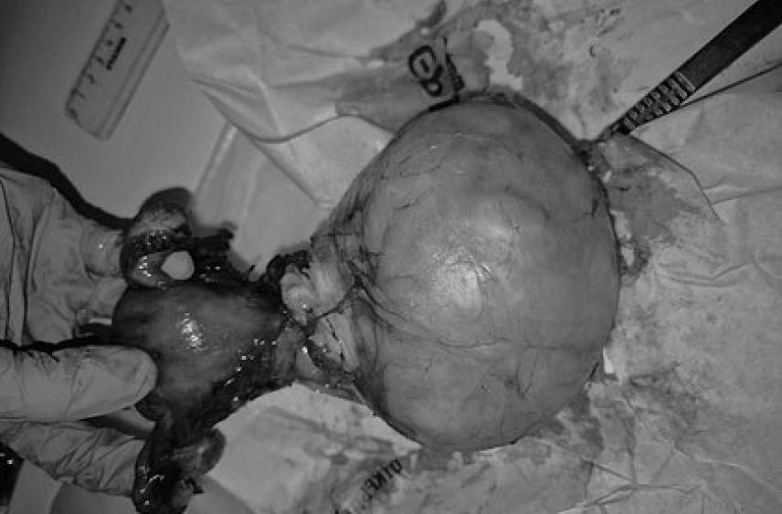 Опухоль размером с волейбольный мяч выросла в теле россиянки