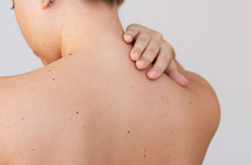 Онколог Орлова посоветовала следить за состоянием родинок