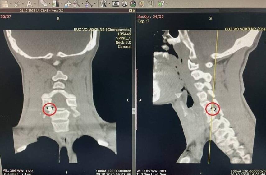 Вологодские нейрохирурги извлекли осколок снаряда из позвоночника бойца СВО
